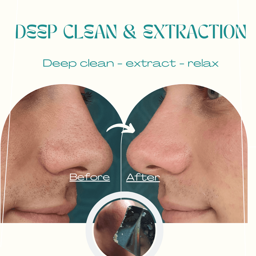 Deep Clean & Extraction - Visible Results Deep clean facial extraction treatment results Hope Island Gold Coast medispa